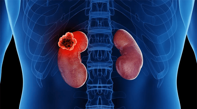 Cáncer de Riñón