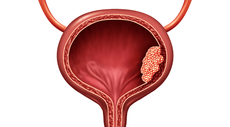 Cáncer de Vejiga