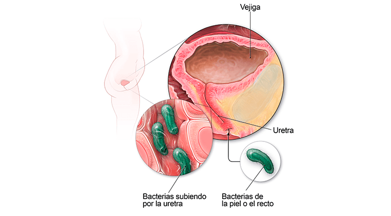 Infecciones del Tracto Urinario (ITU)