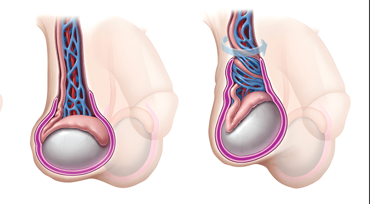 Torsión Testicular