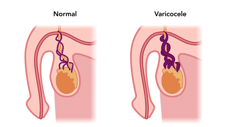 Cirugía de Varicocele e Infertilidad Masculina