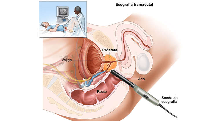 Diagnóstico y Tratamiento del Cáncer de Próstata