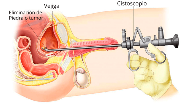 Endoscopia de Vejiga y Uréter (Cistoscopia / Ureteroscopia)