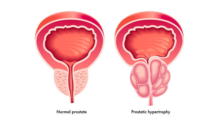 Manejo de la Hiperplasia Prostática Benigna (HBP)