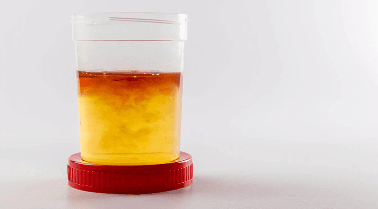 Sangre en la orina (Hematuria)