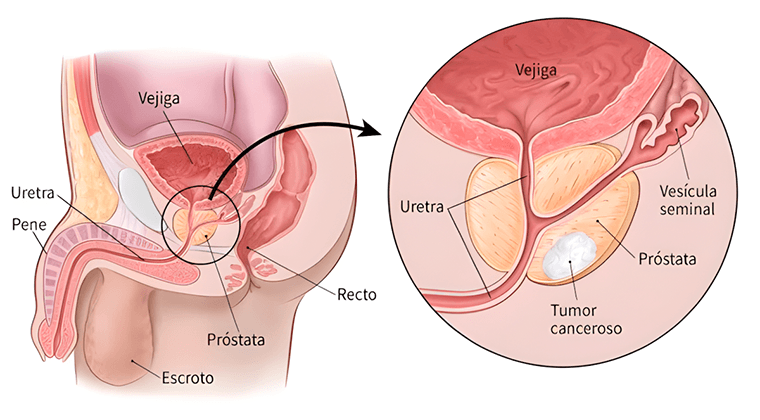 Cáncer de Próstata