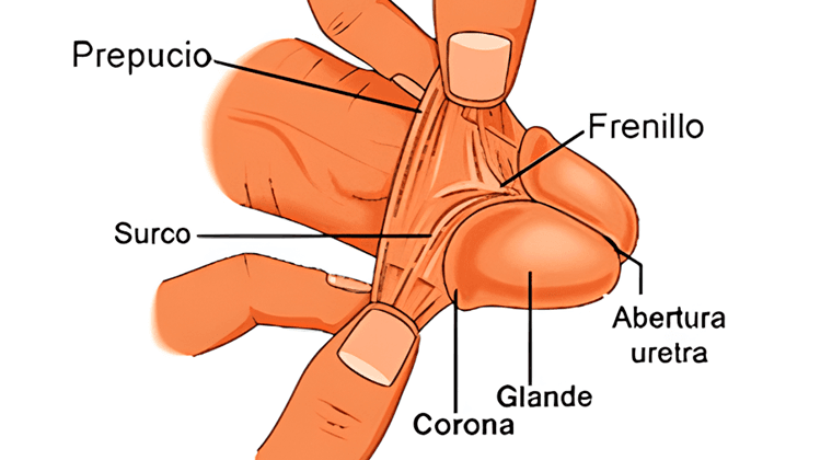Frenillo Corto de Pene