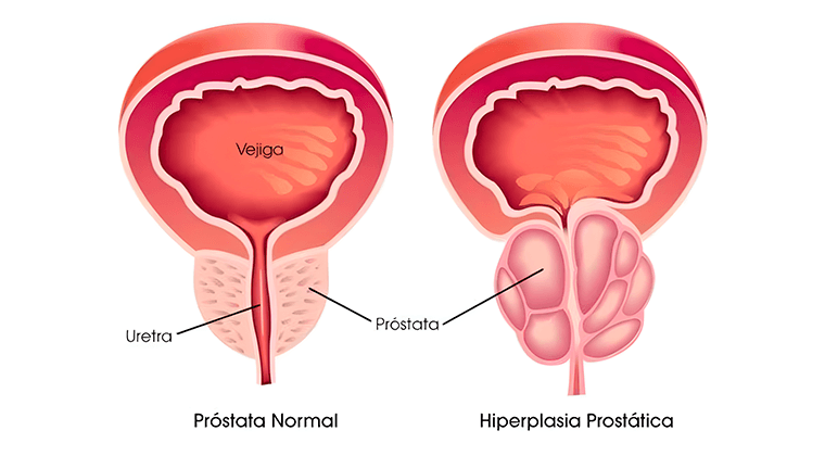 Hiperplasia Benigna de Próstata (HBP)