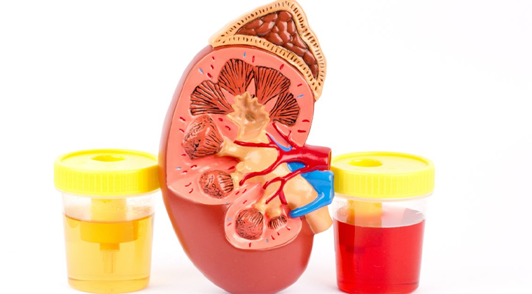 Imagen de Hematuria (Sangre en la orina)
