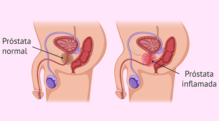 Imagen de Prostatitis