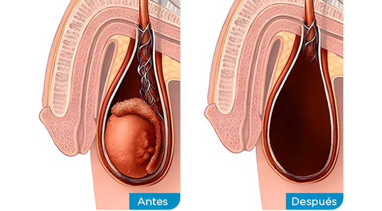 Cirugía Oncológica de Testículo